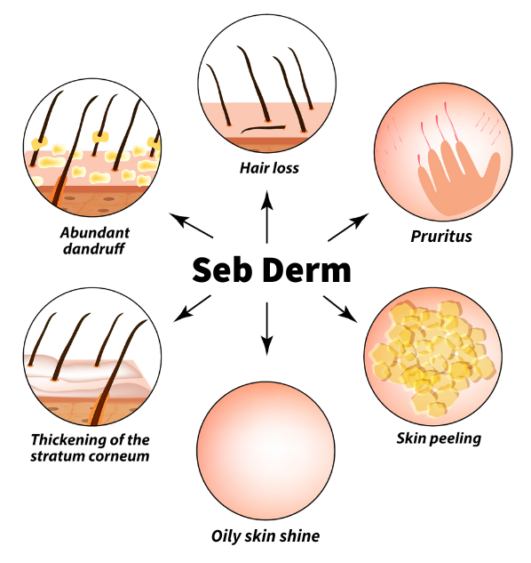 seb-derm-symptoms